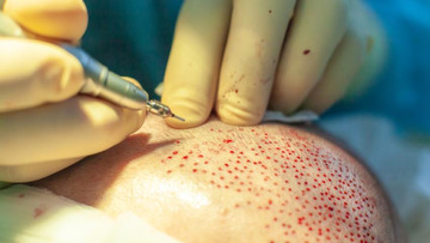 FUT Saç Ekimi - Tatvan Saç Ekimi