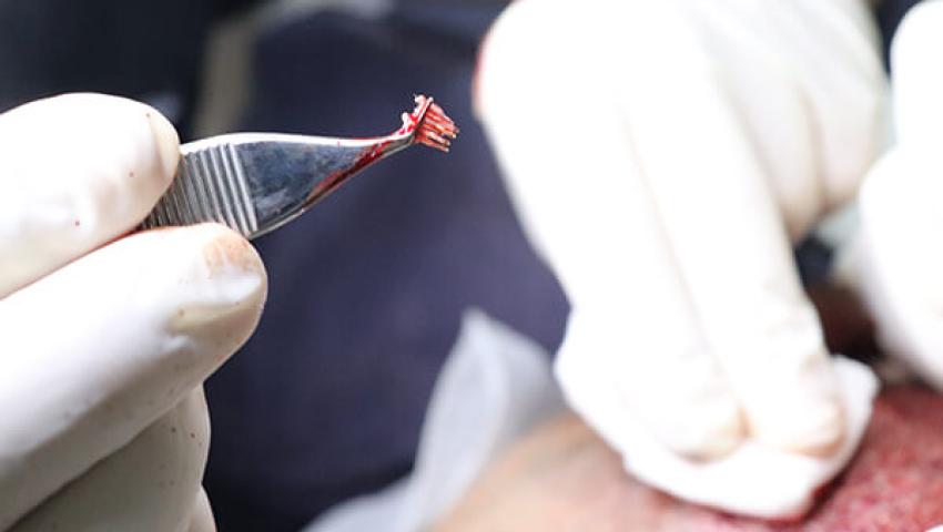 DHI Saç Ekimi - Tatvan Saç Ekimi