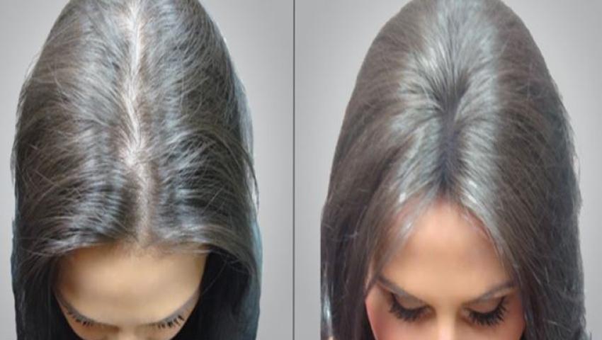 Kadınlar İçin Saç Ekimi - Tatvan Saç Ekimi